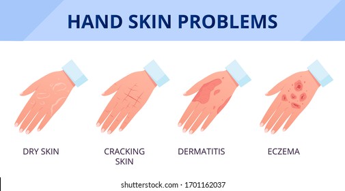 Problemas de piel de mano. Sequedad de piel con grietas, dermatitis y eccema. Las consecuencias del cuidado inadecuado y del frecuente lavado y desinfección de las manos. Ilustración vectorial plana.