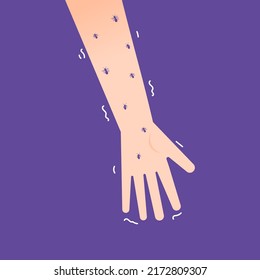 eine Hand, die von Ameisen geschwärmt wird. Symptome wie Kribbeln, Parästhesien, Zittern, Handschütteln und Taubheitsgefühl. Handkrankheit. Gesundheitsprobleme. Illustrationsdesign