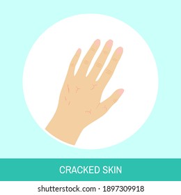 Hand Vector Illustration. Circle Icon With, Cracked Skin, Text Sign. Image Of Female Hand With Cracked Skin Top View For Medical Articles, Posters And Banners.