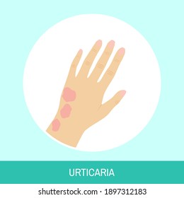 Hand vector illustration. Circle icon with, Urticaria, text sign. Image of female hand with urticaria (hives)  top view for medical articles, posters and banners.