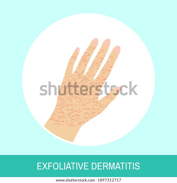 Hand vector\
illustration. Circle icon with, Exfoliative dermatitis, text sign.\
Image of female hand with exfoliative dermatitis, top view for\
medical articles, posters and\
banners.