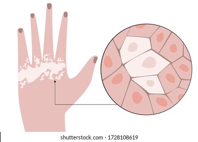 Main avec vitiligo et la structure des cellules de la peau d'un patient avec la déshigmentation et les problèmes de mélanine. Illustration vectorielle à plat avec la peau de vitiligo comme concept de dermatologie