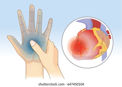 Hand weakness symptom can be warnings signs of a heart attack disease.