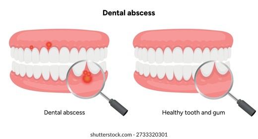 Hand-drawn comparison between tooth with dental abscess and healthy teeth. The infographic highlights infection, pus accumulation, and inflamed gums next to normal healthy tooth anatomy zoom
