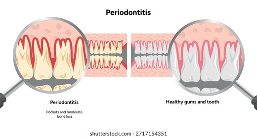 Ilustración dental dibujada a mano con las filas superior e inferior expandidas de dientes con problemas periodontales en comparación con dientes sanos en zoom