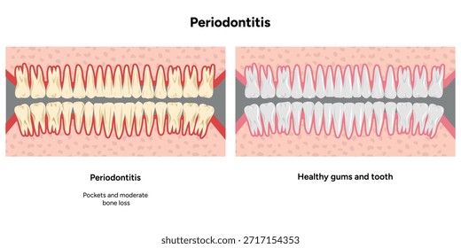 Ilustración dental dibujada a mano con las filas superior e inferior expandidas de dientes con problemas periodontales en comparación con dientes sanos