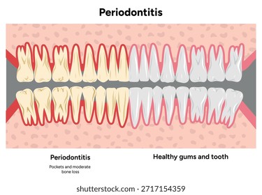 Ilustración dental dibujada a mano con las filas superior e inferior expandidas de dientes con problemas periodontales en comparación con dientes sanos