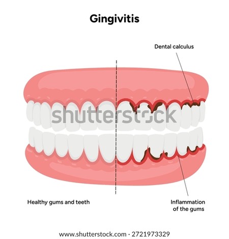 Hand-drawn dental illustration teeth with gingivitis with signs and symptoms. Educational medical infographic highlighting gum redness, swelling, bleeding gums, and plaque buildup