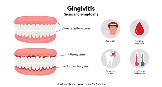 Infografía dental dibujada a mano que muestra la gingivitis y las causas de la recesión gingival. Ilustración educativa que explica la inflamación de las encías, el retroceso de las encías y los problemas periodontales