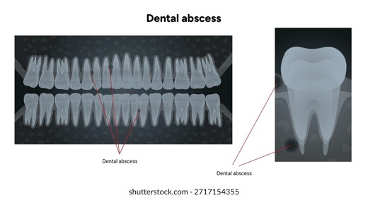 Hand-drawn dental infographic upper and lower teeth with dental abscess, shown in X-ray style, including detailed X-ray illustration of single affected tooth
