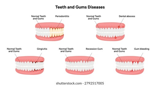 Hand-drawn illustration set showing common dental and gum problems, including periodontitis, gingivitis, gum recession, dental abscess, and gum bleeding. Educational infographic