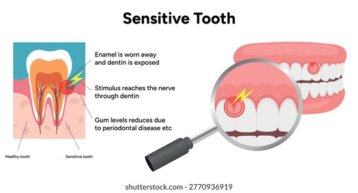 Hand-drawn illustration of tooth sensitivity with visual examples teeth. Educational enamel wear, exposed dentin, and reaction to hot and cold stimuli. causes of tooth sensitivity and oral discomfort