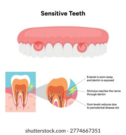 Hand-drawn illustration of tooth sensitivity with visual examples teeth. Educational enamel wear, exposed dentin, and reaction to hot and cold stimuli. causes of tooth sensitivity and oral discomfort