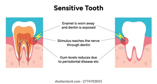Hand-drawn illustration of tooth sensitivity with visual examples teeth. Educational enamel wear, exposed dentin, and reaction to hot and cold stimuli. causes of tooth sensitivity and oral discomfort