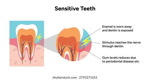 Hand-drawn illustration of tooth sensitivity with visual examples teeth. Educational enamel wear, exposed dentin, and reaction to hot and cold stimuli. causes of tooth sensitivity and oral discomfort