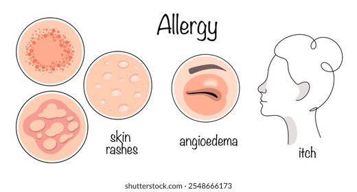 Manifestações principais de alergias desenhadas à mão na forma de erupções cutâneas, inchaço no rosto e coceira no nariz, olhos e ouvidos. A reação do corpo humano aos alérgenos. Vetor de cores médico.