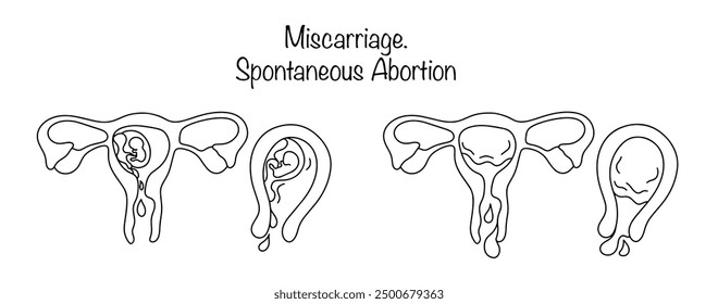 Hand-drawn process of spontaneous abortion. Expulsion of the fetal sac from the uterus through the natural birth canal. Medical illustration on the topic of gynecology. Vector illustration.