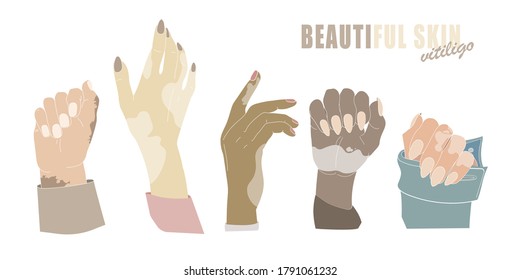 Hands with age spots or vitiligo isolated vector. Hand gestures with genetic skin disease. Woman's hands with manicure