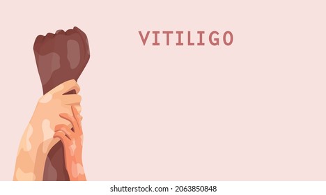 Hands with depigmentation. The concept of different beauty, self-acceptance. Skin diseases. Vector illustration of a cartoon. A banner with space for text.