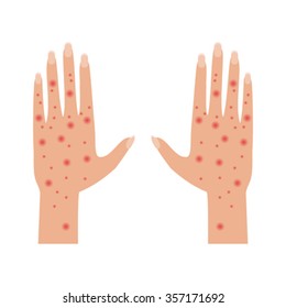 Hands with dermatologic disease of the skin, rash, eczema
