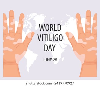 Hands with dermatological disease vitiligo. Medicine concept. World vitiligo day, awareness banner. Banner, poster, vector