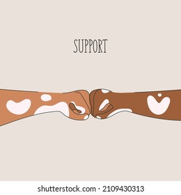 Hands of different skin color with vitiligo disease support each other with love. Flat vector illustration