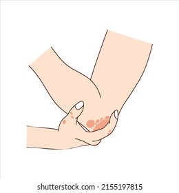 Las manos y el codo con erupciones cutáneas psoriasis