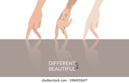 The hands of a normal, vitiligo, albino move together over the surface and are reflected on it. Vector graphics for World Vitiligo Day and International Albinism Awareness Day. Flat design.