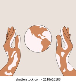 hands of a person with vitiligo skin disease carefully hold the planet flat vector illustration