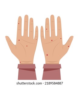 Hands with pimples, problem skin of the hands. Dermatological problems. Allergy on the skin of hands, palms.