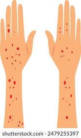 
Hands with Rash Symptoms Vector Cartoon illustration. Person suffering from a skin disease or something infectious 
