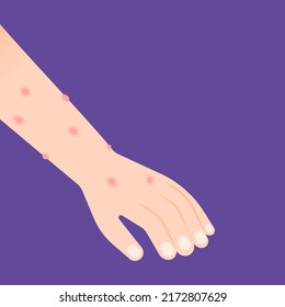 Hands With Red Blotches Or Red Spots. Symptoms Of Chickenpox, Monkeypox, Allergies, Measles. Skin Disease. Health Problems. Illustration Design