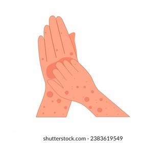 Hands scratch arm in red spot Rash skin on hand allergy symptoms on hands medical and healthcare