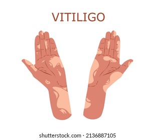 Hands with vitiligo disorder. Poster for supporting people living with vitiligo.