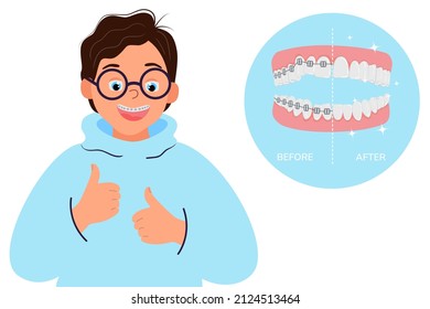 Happy child shows thumbs up. Smiling boy showing braces, isolated on white background. Under a magnifying glass, uneven teeth in the bracket system and straight after treatment. Vector illustration