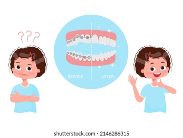 Happy child shows thumbs up. Smiling girl showing braces, isolated on white background. Under a magnifying glass, uneven teeth in the bracket system and straight after treatment. Vector illustration