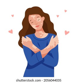 Happy girl with vitiligo hugs herself by the shoulders. World vitiligo day. A woman loves her body. Self care. Vector flat illustration.