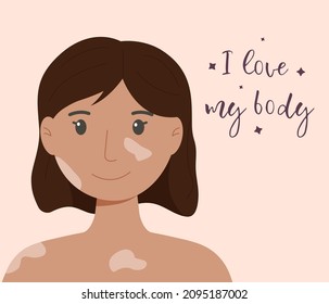 Happy girl with vitiligo. World vitiligo day. Skin disease.
