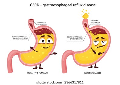 Happy healthy stomach and gastroesophageal reflux disease cartoon characters. Gastric yellow juice in normal and GERD stomach. Vector illustration isolated on white background
