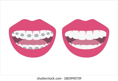 Sonrisas felices mostrando antes y después del proceso de alineación y blanqueamiento de dientes. Alineación del mordisco de los dientes, fila dental con llaves, concepto de salud ortodoncia. Ilustración del vector