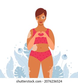 Happy woman with vitiligo. Concept of supporting people living with vitiligo and raising awareness of chronic skin diseases. Vector illustration.