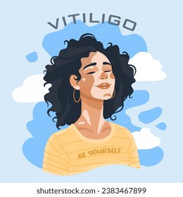 Mujer feliz con problemas cutáneos de Vitiligo. Día Mundial del Vitiligo