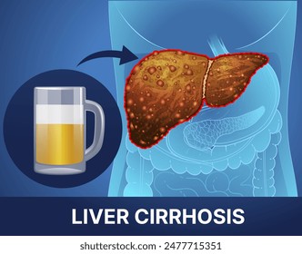 The harm of alcohol. Liver disease. Cirrhosis of the liver. Social illustration. Healthcare illustration. Vector illustration.