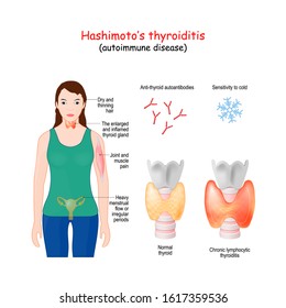 Hashimoto's thyroiditis. chronic lymphocytic thyroiditis is an autoimmune disease in which the thyroid gland is gradually destroyed. Vector illustration. Labeled medical scheme