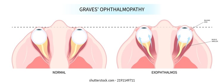 Hashimoto's thyroiditis and Graves' disease eye swollen tumor cancer therapy lump enlargement