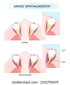 Hashimoto's thyroiditis and Graves' disease eye swollen tumor cancer therapy lump enlargement