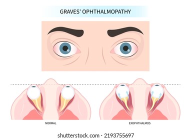 Hashimoto's Thyroiditis And Graves' Disease Eye Swollen Tumor Cancer Therapy Lump Enlargement