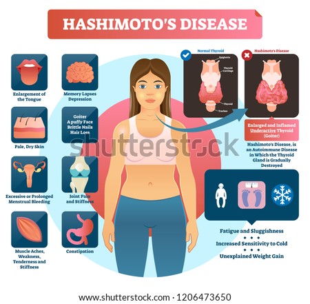 Hashimotos thyroiditis vector illustration. Labeled medical scheme with autoimmune disorder diagnosis and symptoms like tongue enlargement, pale, dry skin and stifness.
