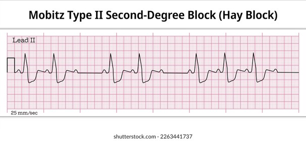 Hay Block - ECG Mobitz Type 2 Second Degree Atrioventricular Block - 2nd degree AV Block - 8 Second ECG Paper - Electrocardiography Vector Medical Illustration