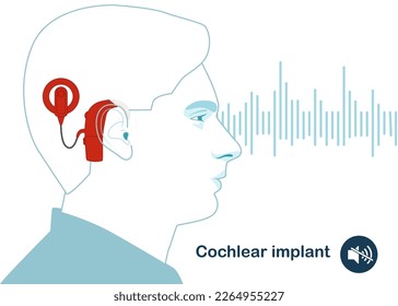 Head with a cochlear implant device in the ear. For the hearing impaired and the deaf, with sound wave. Modern vector illustration in flat style.